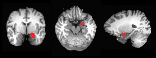 Amygdala