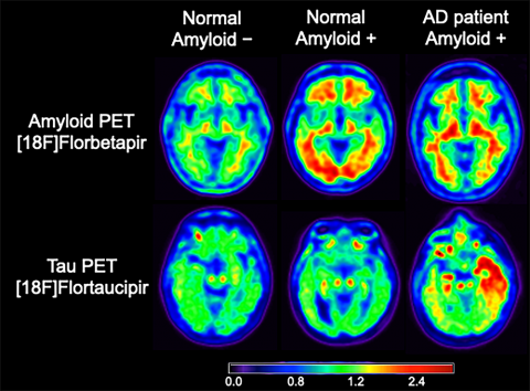 PET scans
